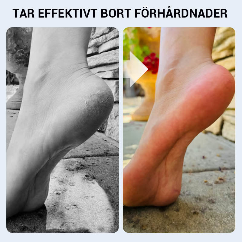 🔥 ﻿Praktický ruční odstraňovač mozolů na nohou🦶🏻